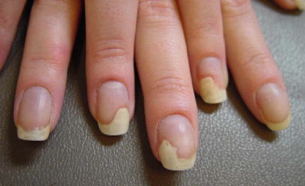 Nail Dystrophy Definition, Causes & Treatment