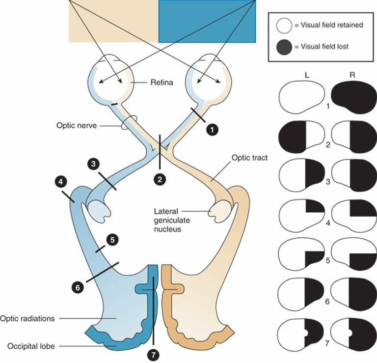 Quadrantanopia definition and causes