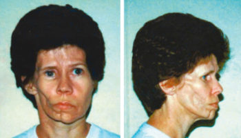 Parry Romberg syndrome