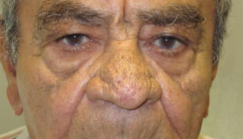 Phymatous rosacea