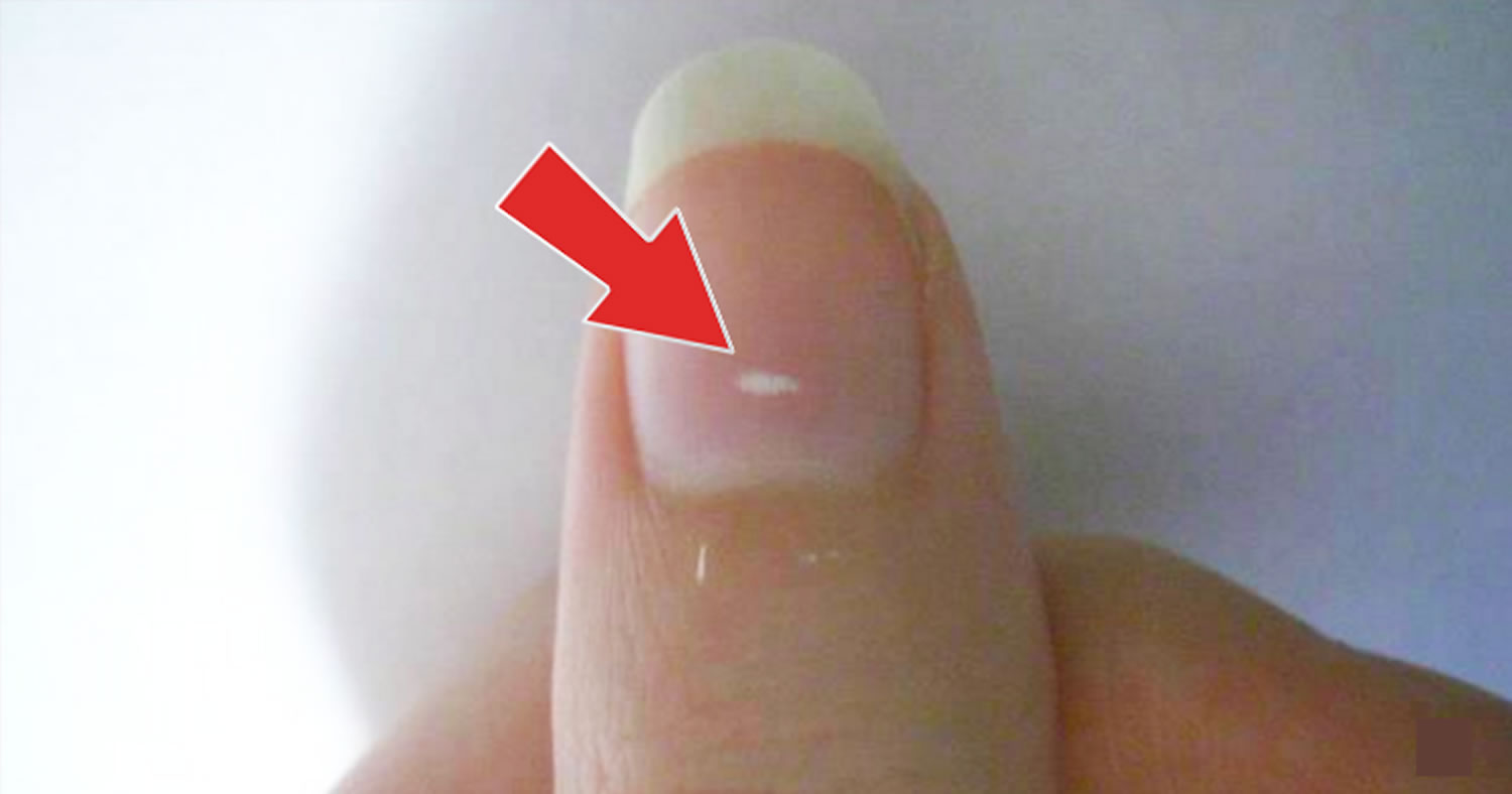 what-those-vertical-lines-on-your-nails-mean-about-your-health