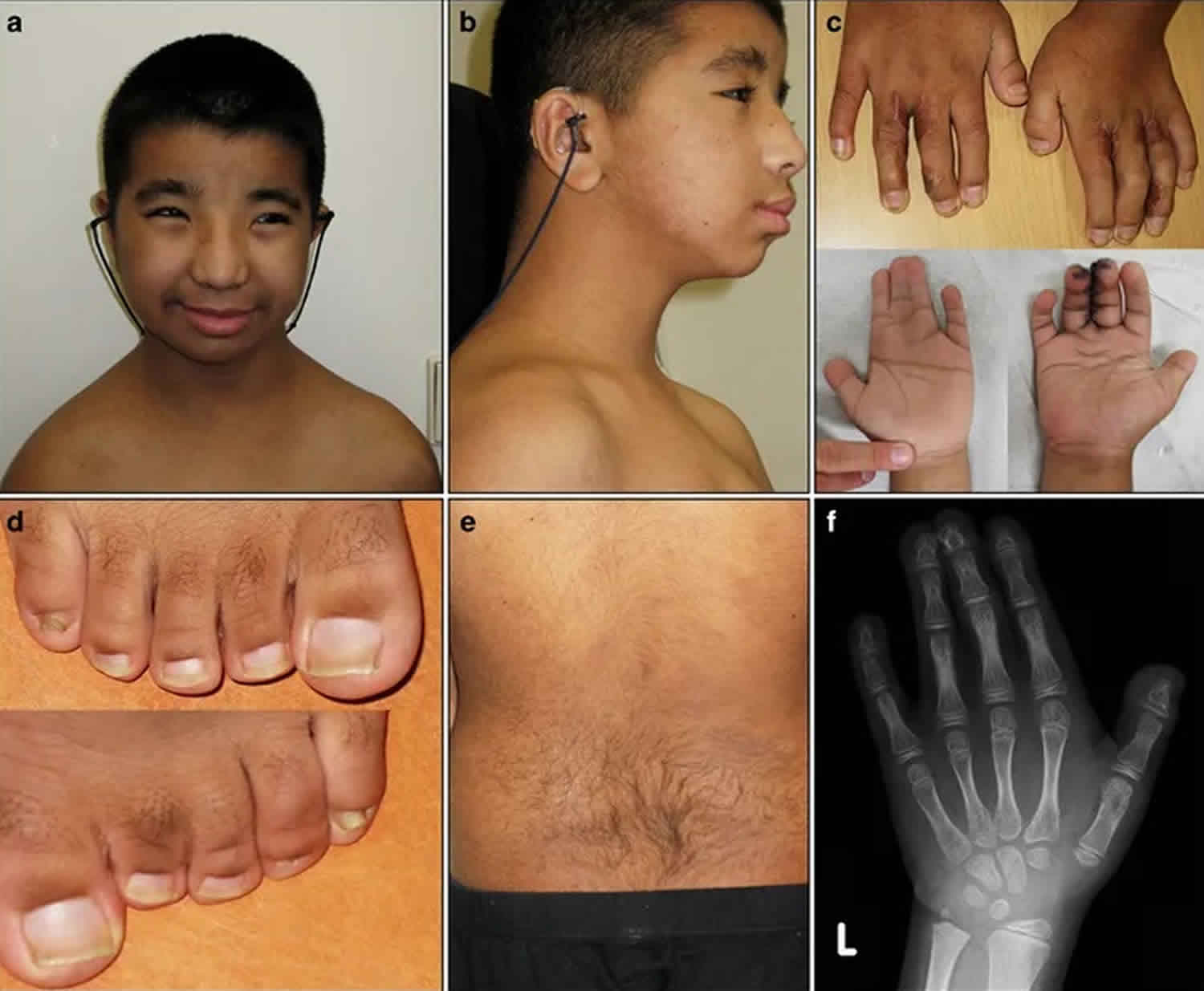 SciELO - Brasil - Broad thumbs and broad hallux: the hallmarks for the  Rubinstein-Taybi syndrome Broad thumbs and broad hallux: the hallmarks for  the Rubinstein-Taybi syndrome