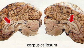 Split brain