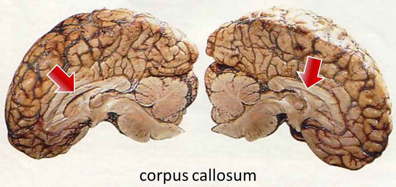 Split brain syndrome definition, causes, symptoms & experiments