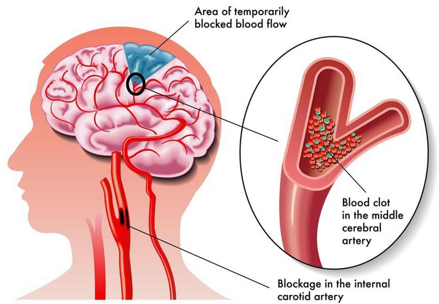 How To Recover From A Tia Stroke