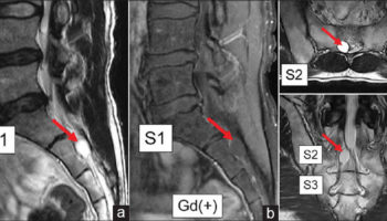 Tarlov cyst