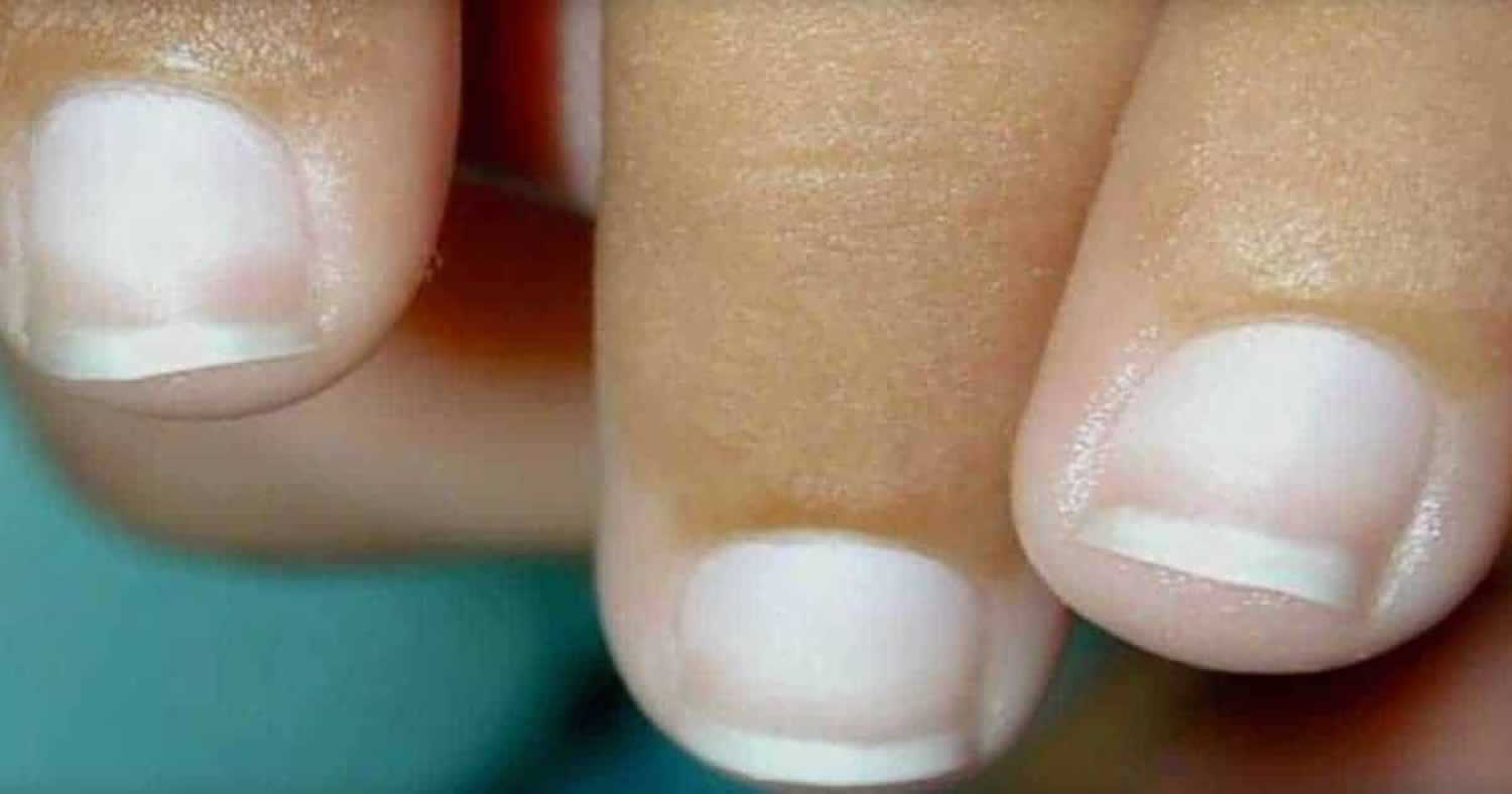 Terry S Nails Causes Differential Diagnosis Treatment