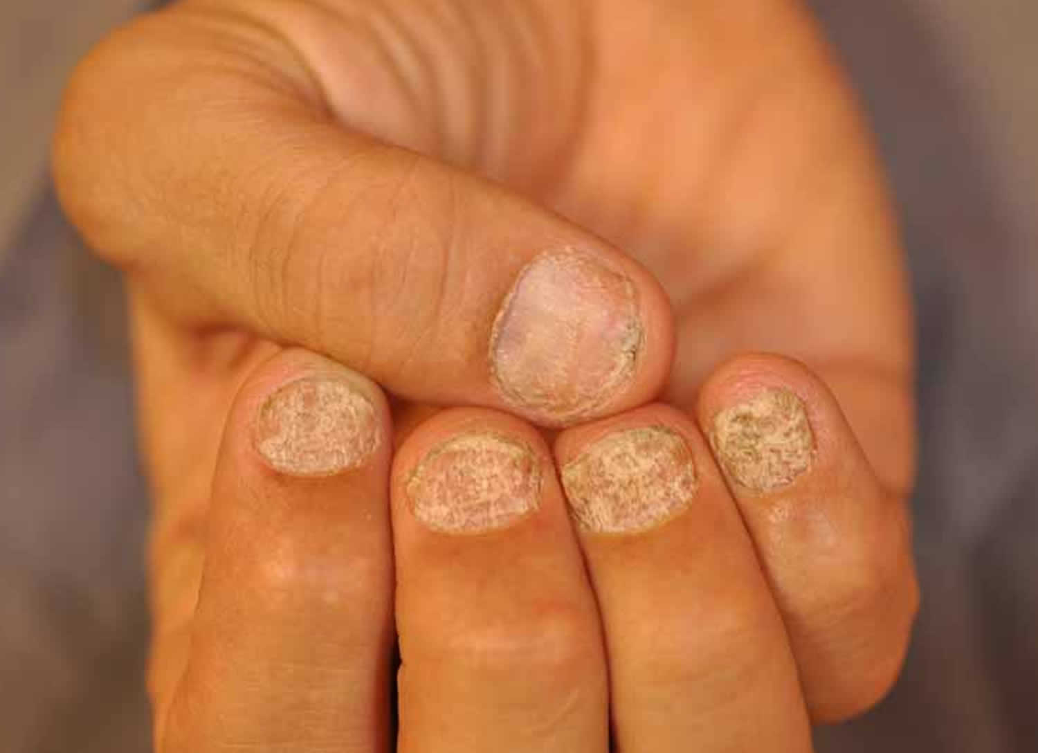 What is nail psoriasis, and how can I treat it?