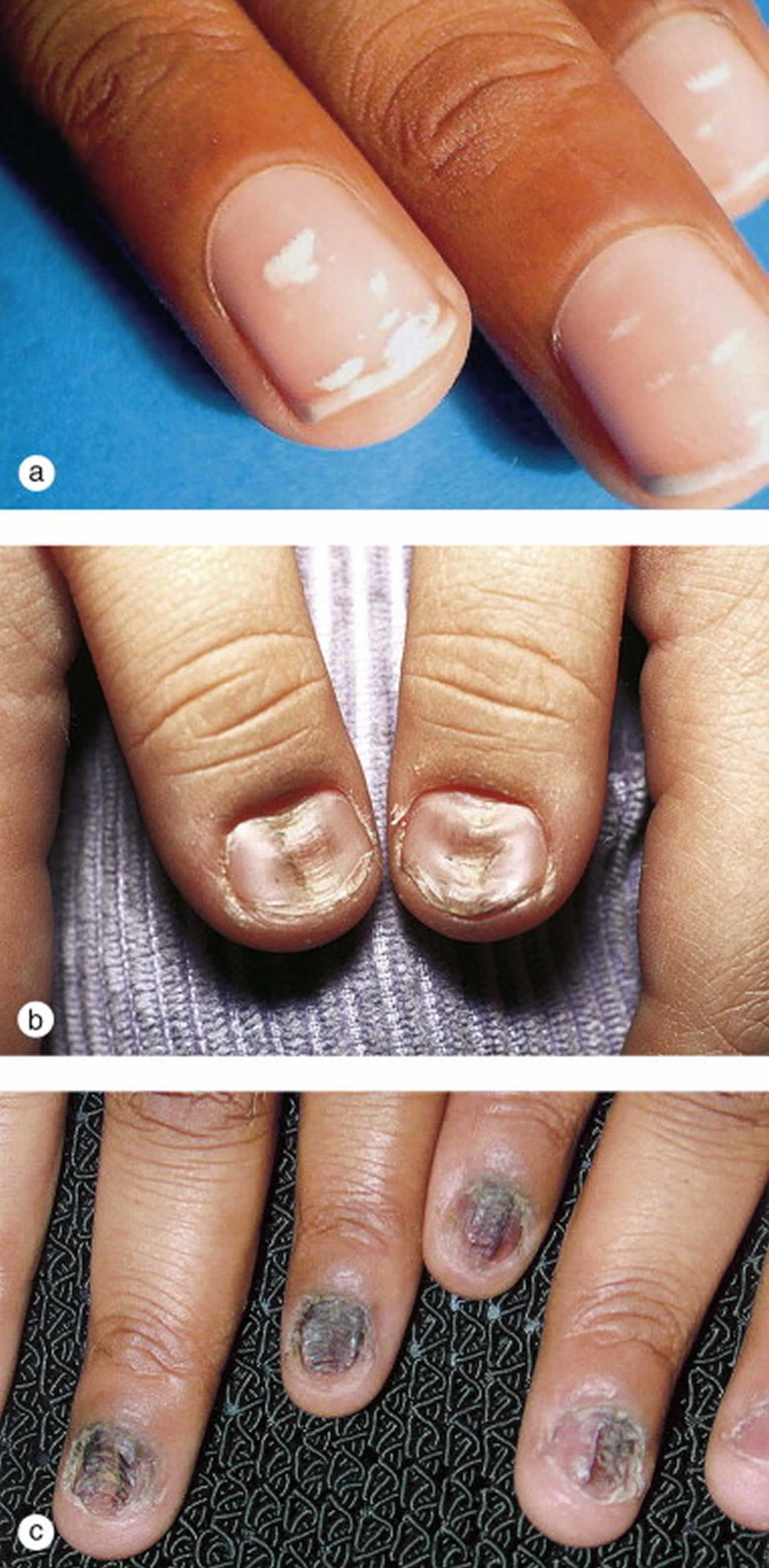 Pathogenesis, Clinical Signs and Treatment Recommendations in Brittle Nails:  A Review