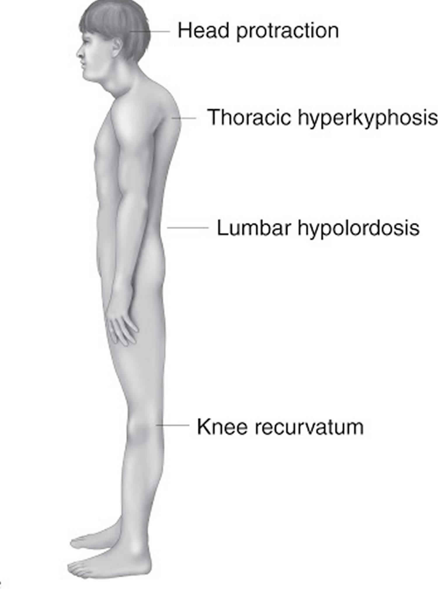 Are You Living with Lower Crossed Syndrome? Physical Therapy Can Help