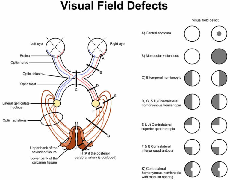 Quadrantanopia definition and causes