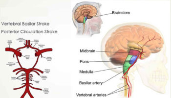Wallenberg syndrome