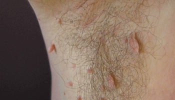 acrochordon