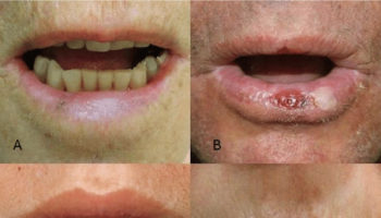 actinic cheilitis
