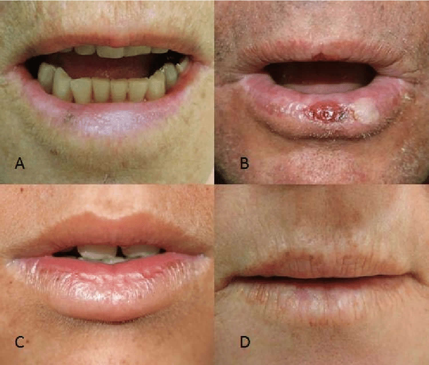 Actinic Cheilitis Causes Signs Symptoms Diagnosis Treatment And Prognosis