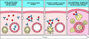 Arthus reaction definition, causes, symptoms & treatment