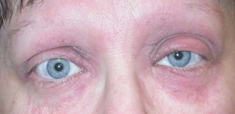 eyelid-dermatitis-causes-symptoms-diagnosis-treatment