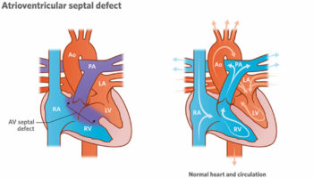 av canal defect