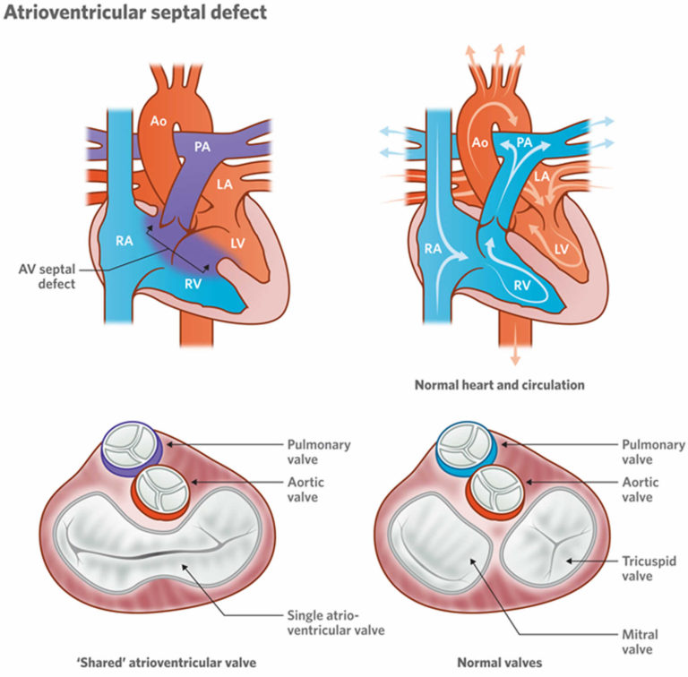 Atrioventricular canal defect causes, symptoms, diagnosis, treatment