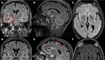 brain atrophy