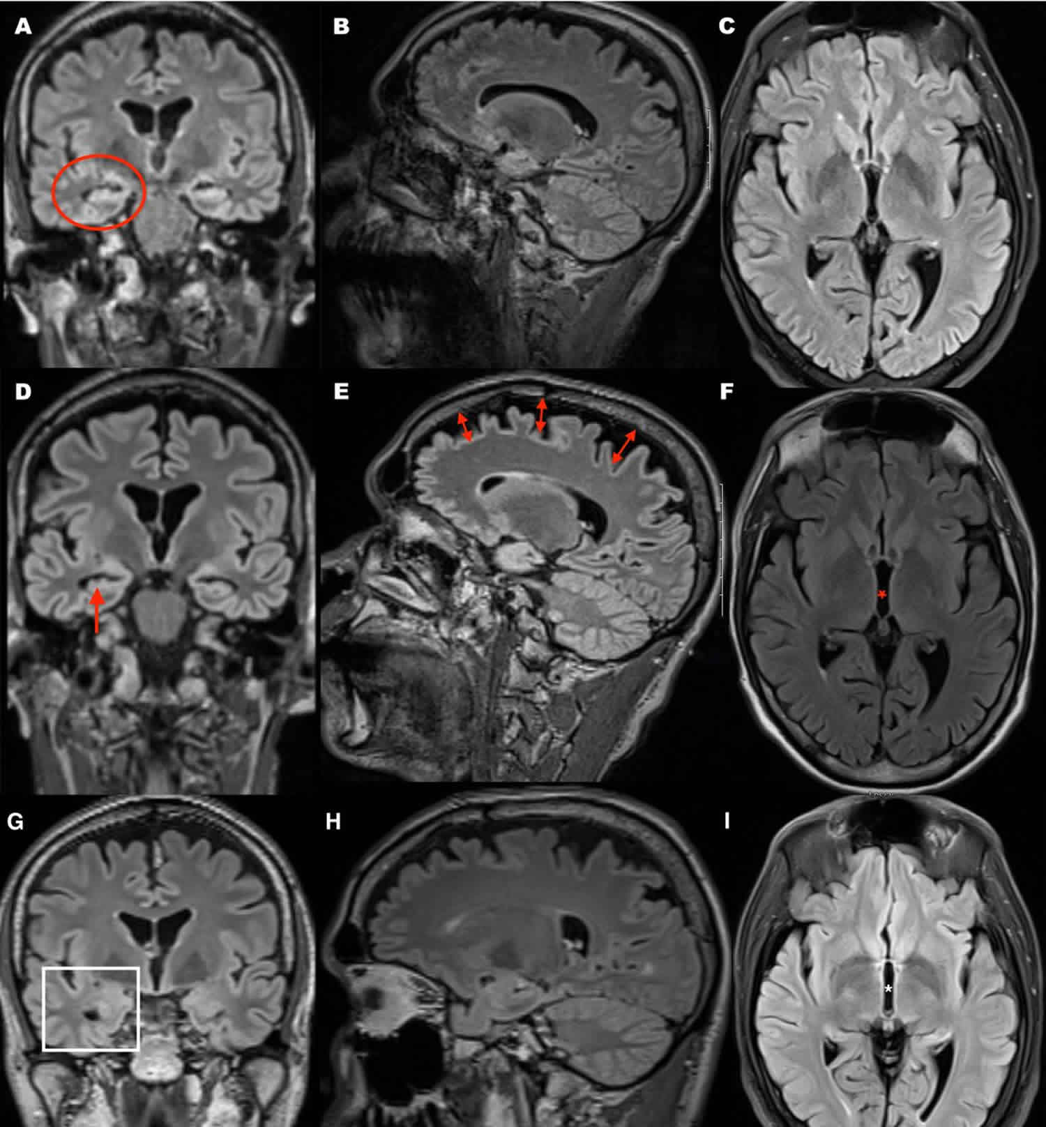 Mild Diffuse Cerebral Atrophy Meaning In Marathi