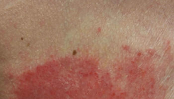 breast eczema