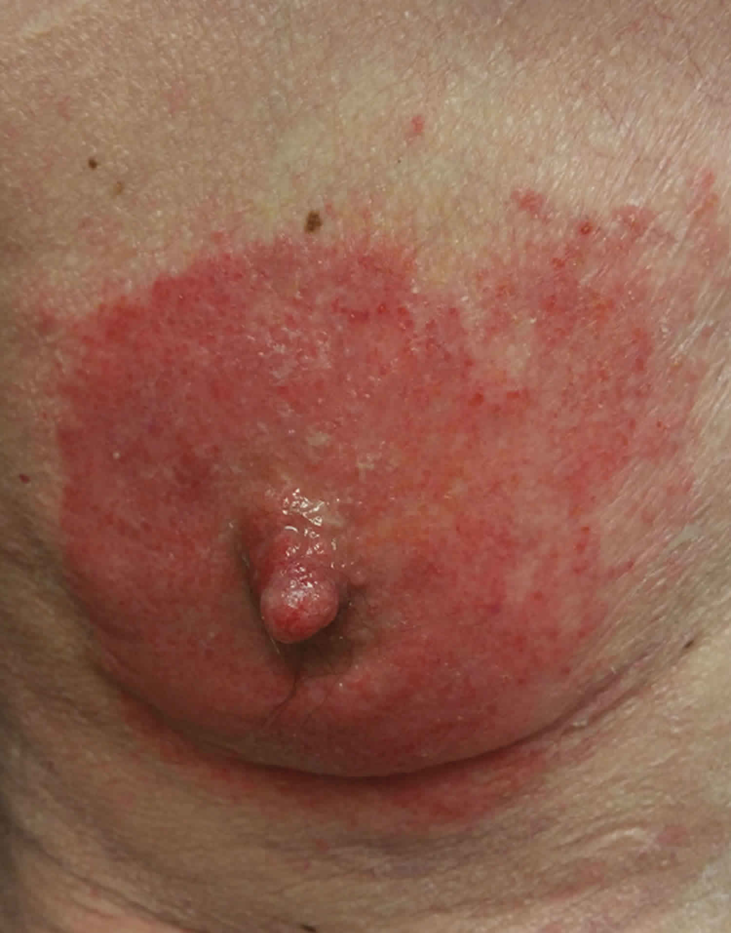 Eczema on my breasts has made my nipples itchy and sore.