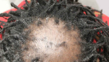 central centrifugal cicatricial alopecia