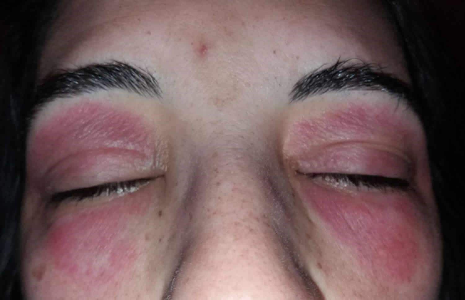Eyelid Dermatitis 