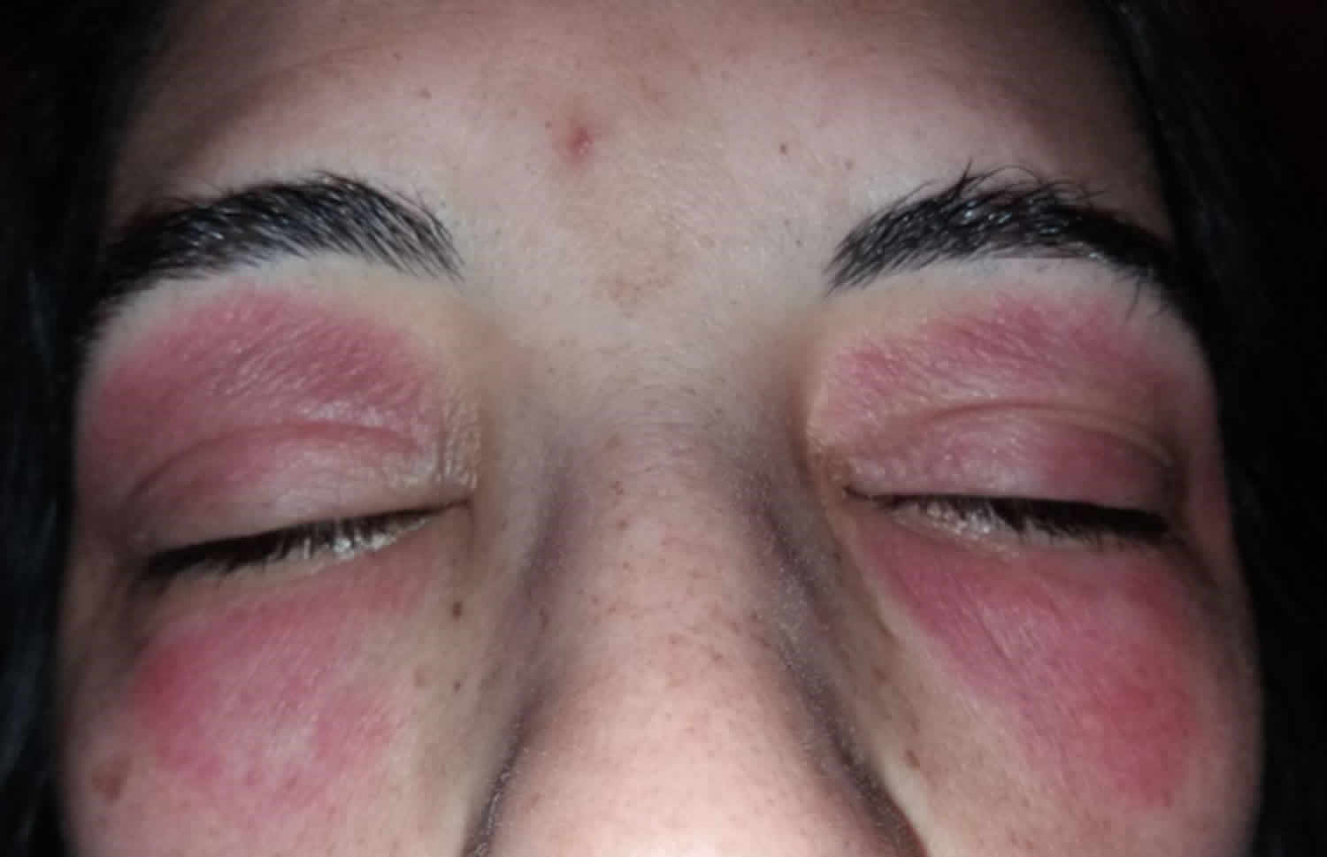 Eyelid Dermatitis