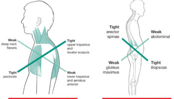 cross syndrome
