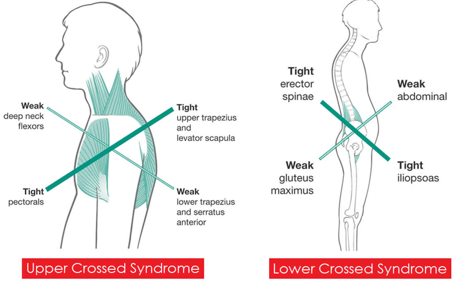 Cross Syndrome Causes Symptoms Diagnosis Treatment And Exercises