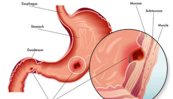 curling ulcer