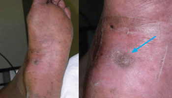 epithelioid hemangioendothelioma