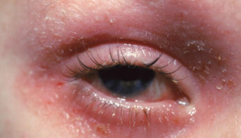 eyelid dermatitis