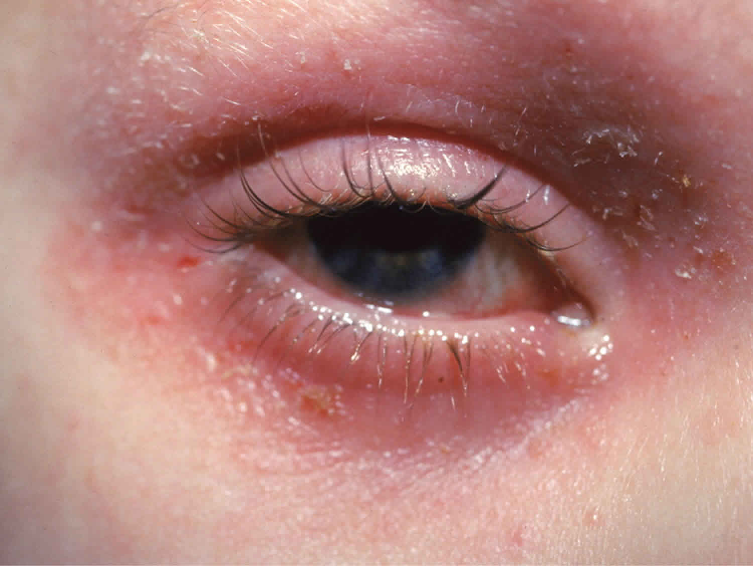 Can Pollen Cause Eyelid Dermatitis