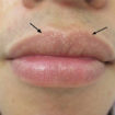 fordyce spots lips