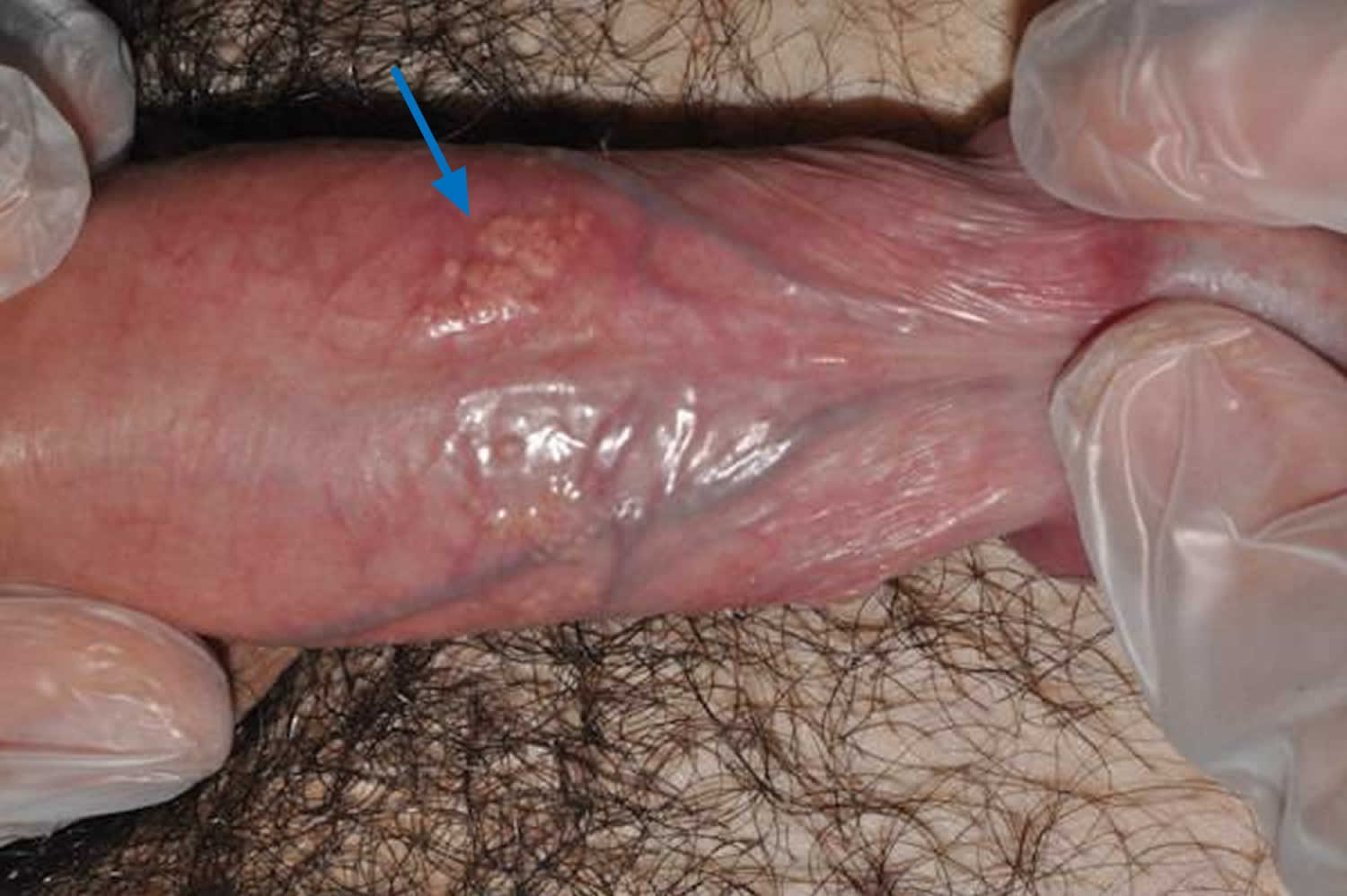 Fordyce spots on shaft of penis.