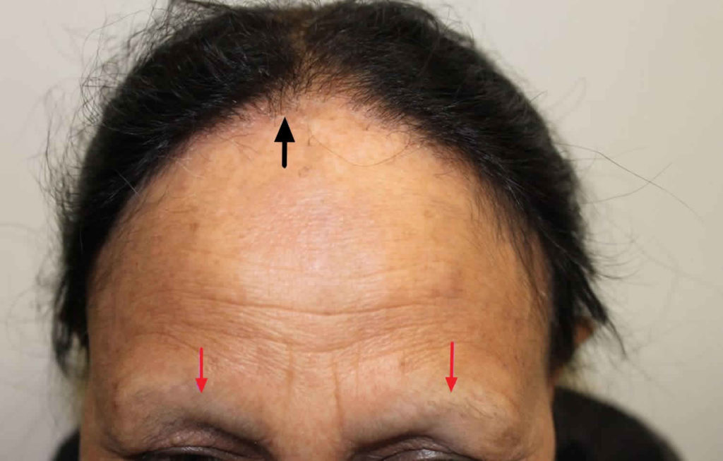 Frontal fibrosing alopecia causes, symptoms, diagnosis, treatment
