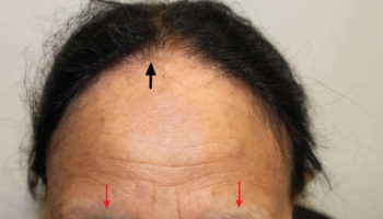 frontal fibrosing alopecia