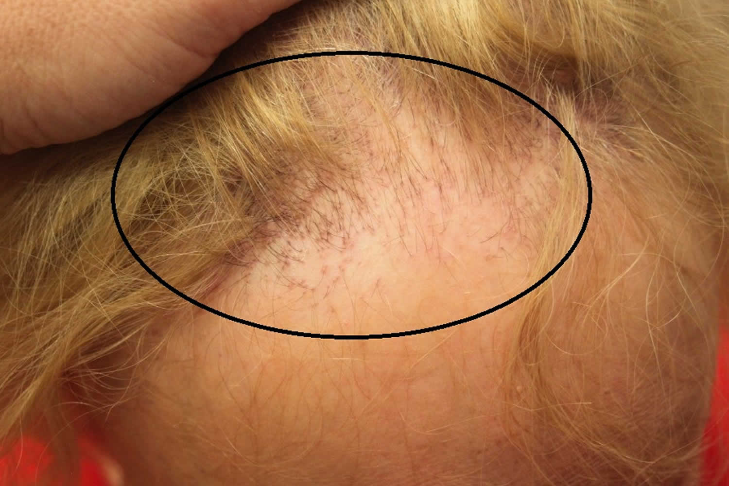 Frontal fibrosing alopecia causes, symptoms, diagnosis, treatment ...