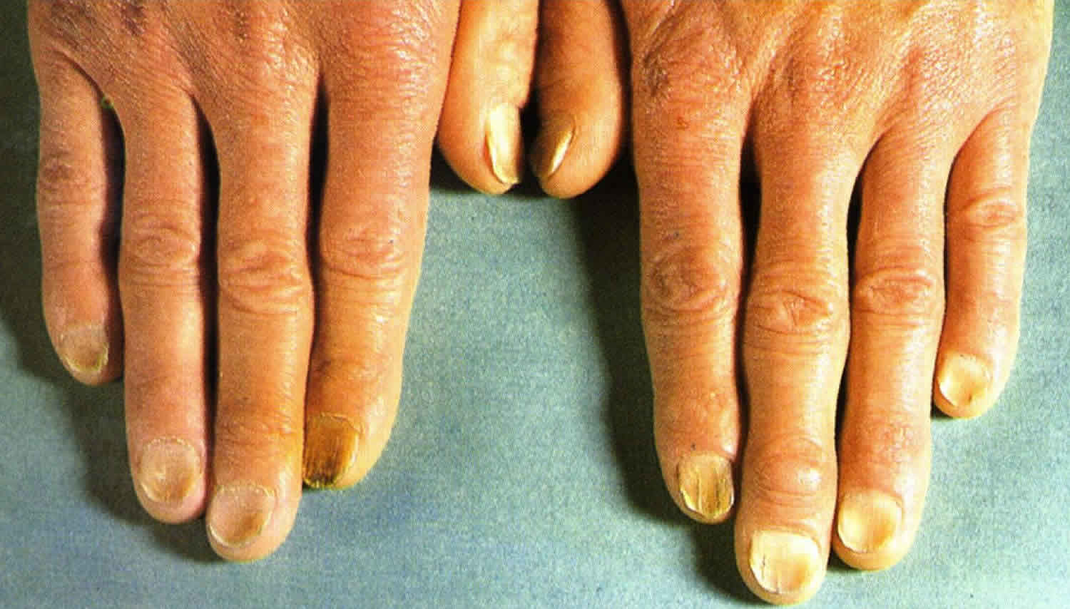 What causes a spoon nail, and how do you cure them? - Quora