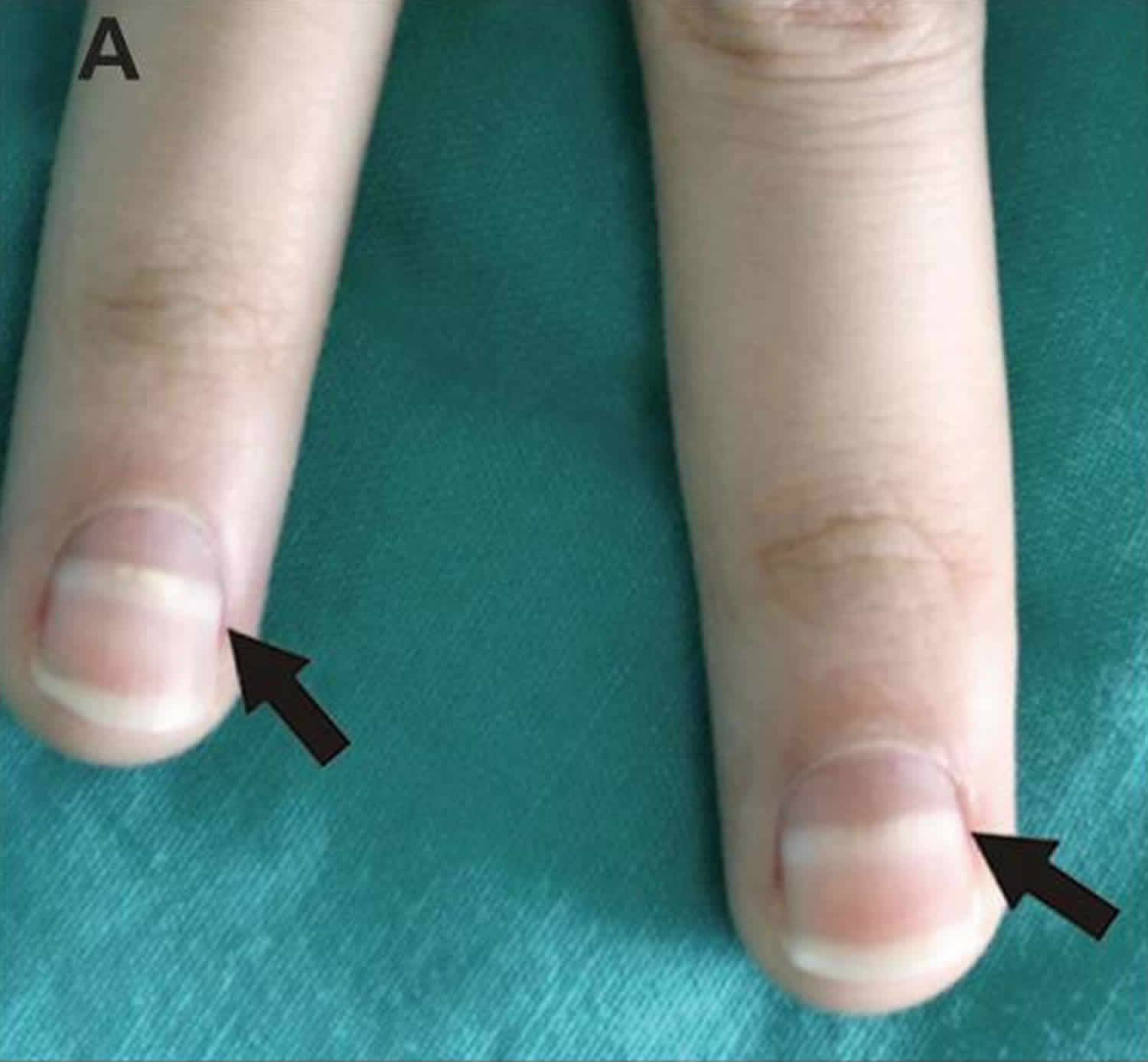 Mees lines fingernails causes, symptoms & treatment