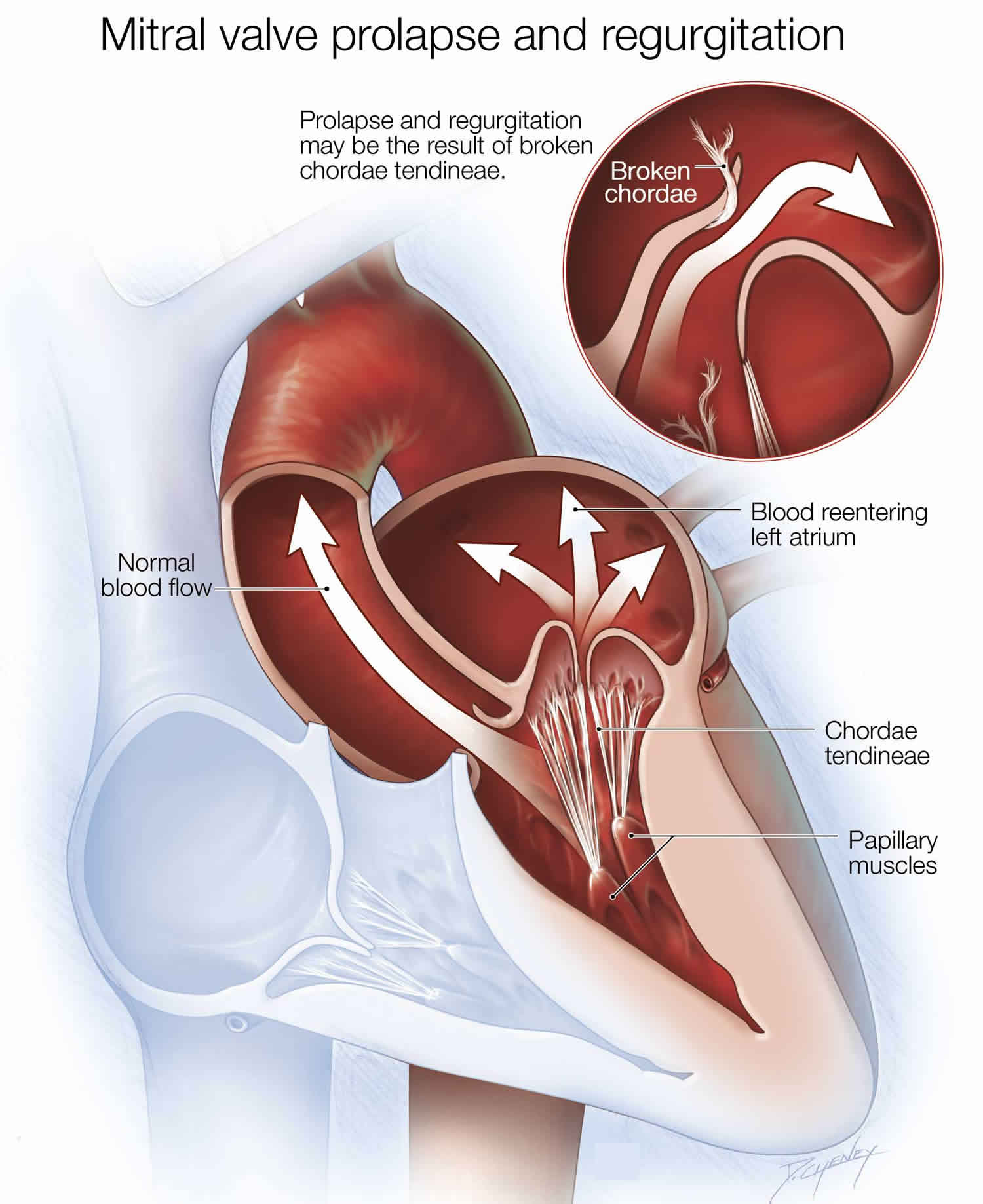 What Are Causes Of Chronic Mitral Regurgitation