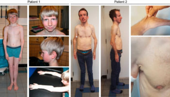 occipital horn syndrome