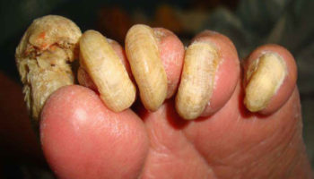 onychogryphosis