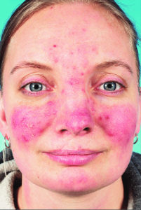 Papulopustular Rosacea Causes, Symptoms, Diagnosis & Treatment