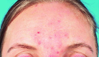papulopustular rosacea