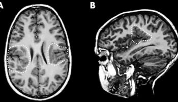 polymicrogyria