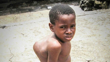 pott’s disease
